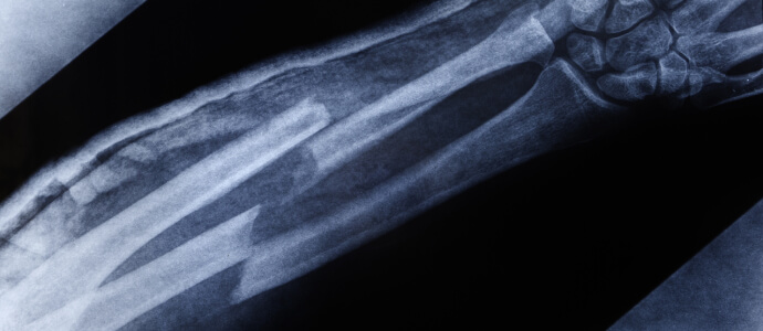 X-ray of broken bones in forearm