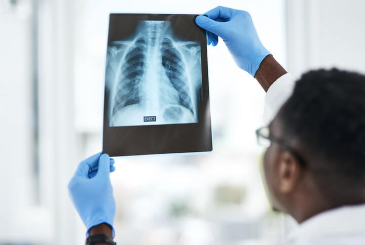 Doctor holding x-ray of broken ribs