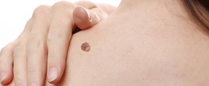 Cancerous mole on a woman's shoulder
